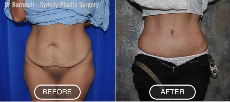 Tummy Tuck Before After