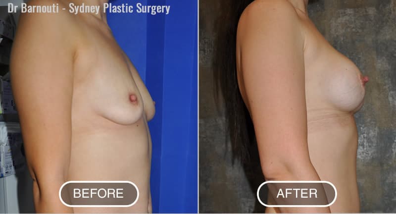 Before and after Abdominoplasty and Breast augmentation
