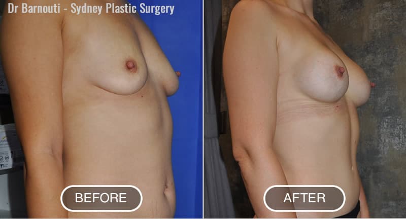 Before and after Abdominoplasty and Breast augmentation