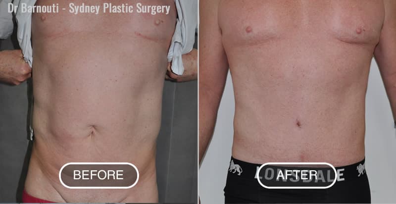 Abdominoplasty and Liposculpture Before and After