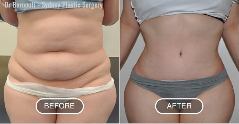 Abdominoplasty and Liposculpture Before After