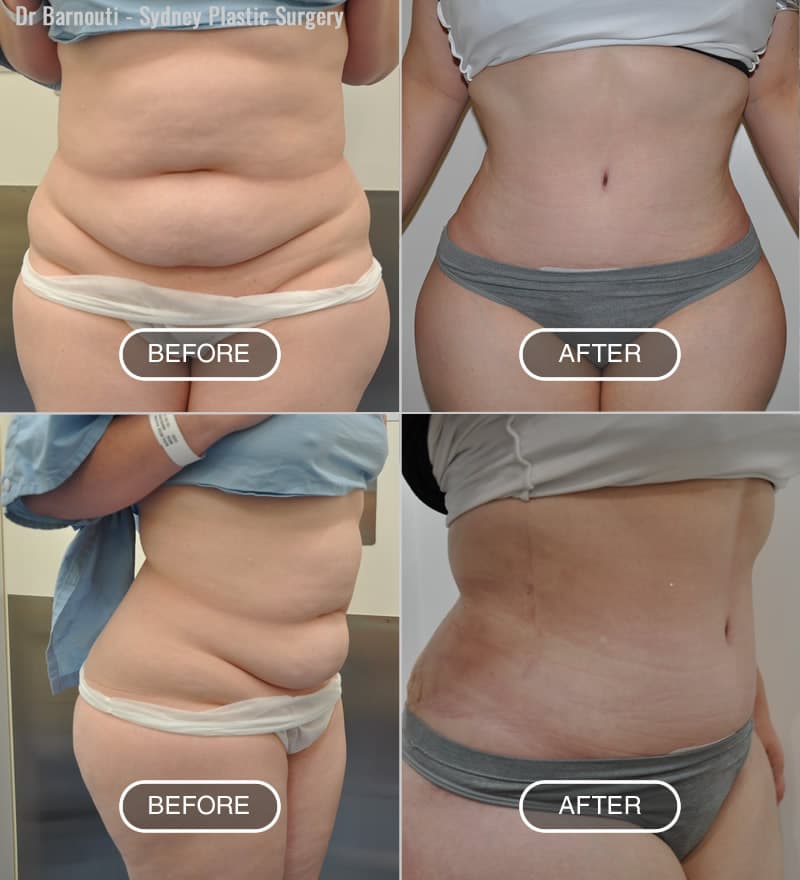 Liposuction - Before After Gallery