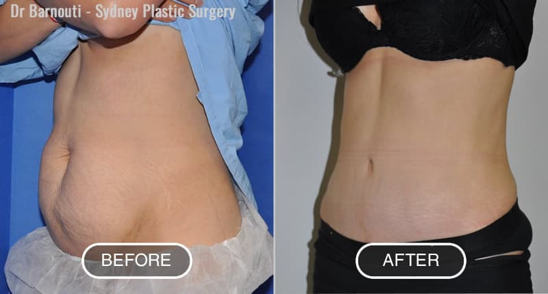 Tummy tuck before after