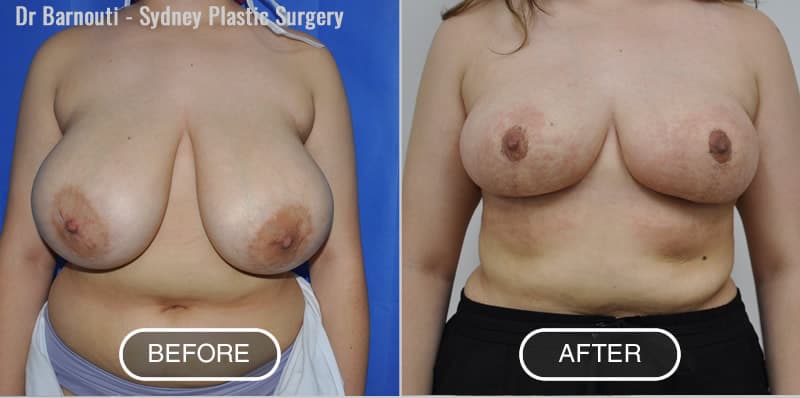 Breast Reduction and Lift, Before and After