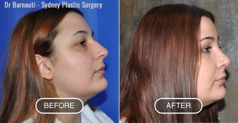 Rhinoplasty Before After