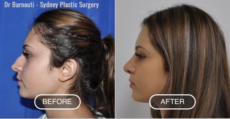 Rhinoplasty Before After Photo