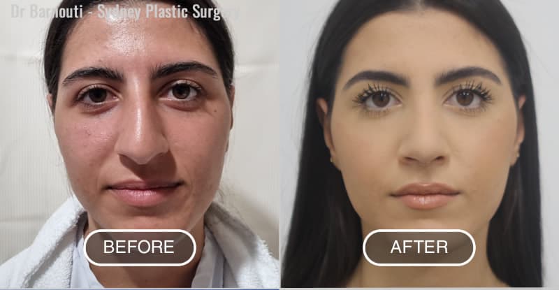 Rhinoplasty Before After Photo