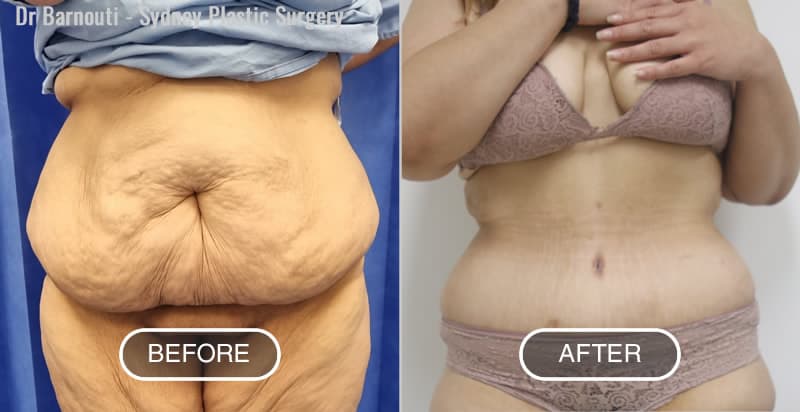 Abdominoplasty - Before and After