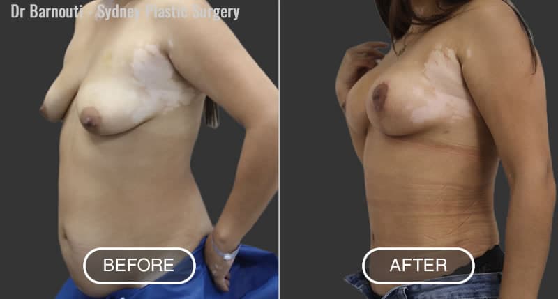 Mummy Makeover - Abdominoplasty, Breast Lift and Augmentation.