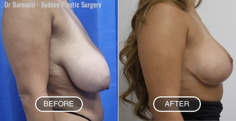 Breast Reduction - Before After