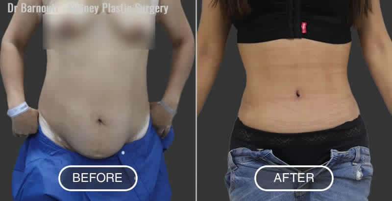 Tummy Tuck Before After Photo