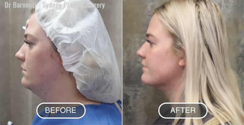 Before and after Neck Liposuction by Dr Barnouti