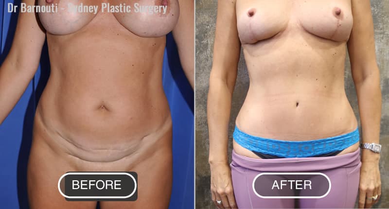 Mummy Makeover and Tummy Tuck Before After