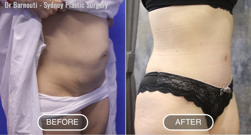 Tummy Tuck Before After