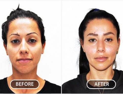 Cheek Augmentation