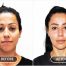 Understanding facial aesthetics is vitally important in producing a natural outcome.