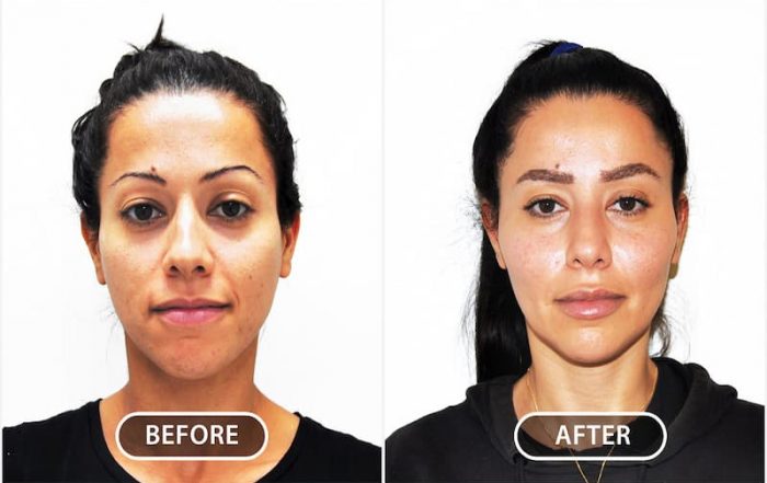 Understanding facial aesthetics is vitally important in producing a natural outcome.