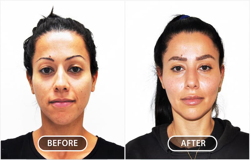 Understanding facial aesthetics is vitally important in producing a natural outcome.