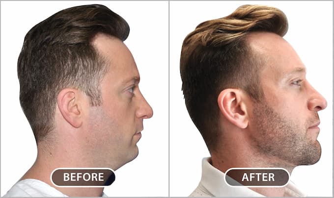 In the after photo, notice the well-defined jaw line and the chin projection.