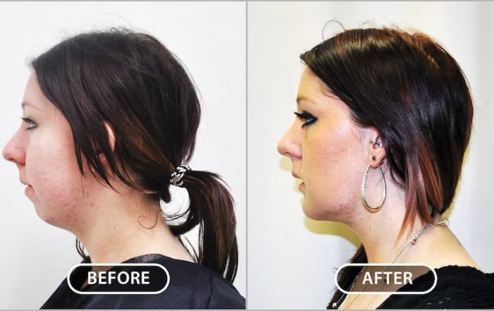 Chin augmentation