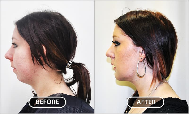 Chin augmentation