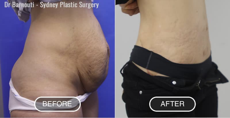 Before After Photos - Sydney Tummy Tuck By Dr Barnouti