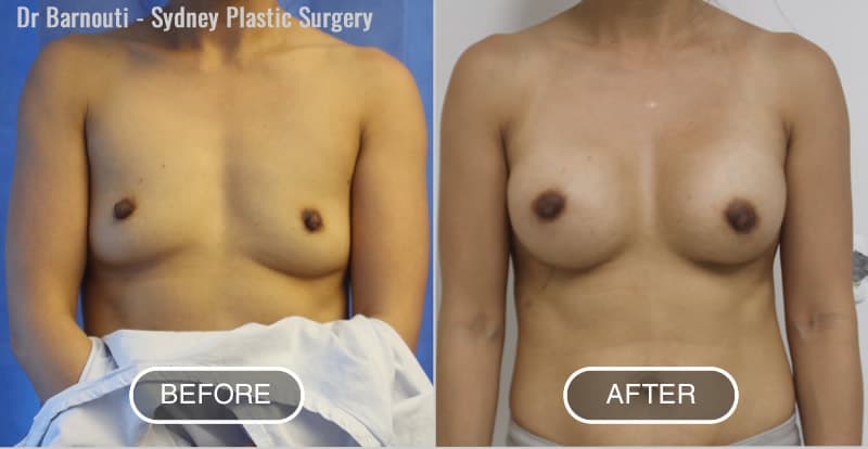 Breast Augmentation Before After