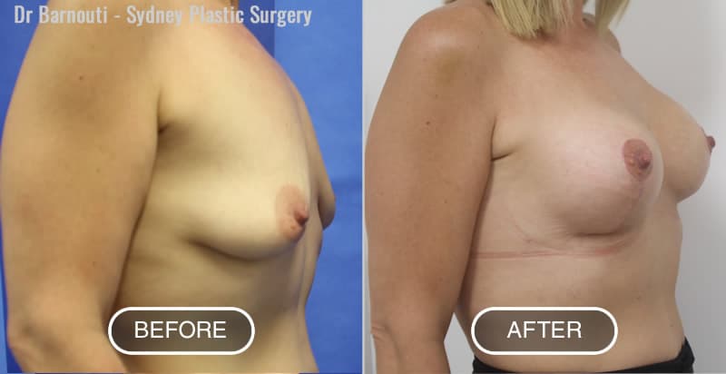 Breast Lift Before After