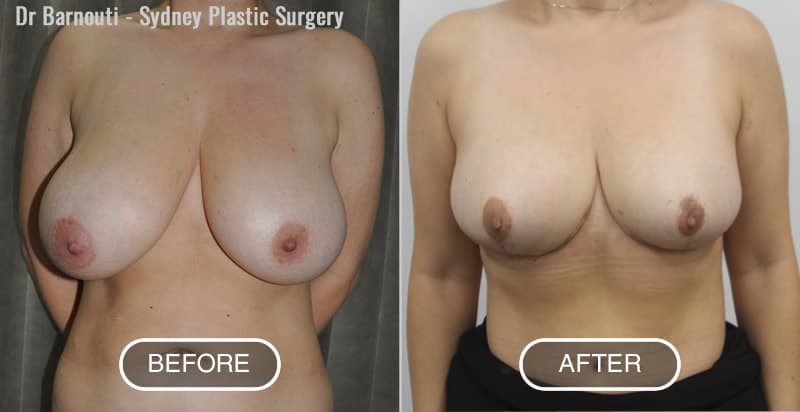 Breast Reduction Before After