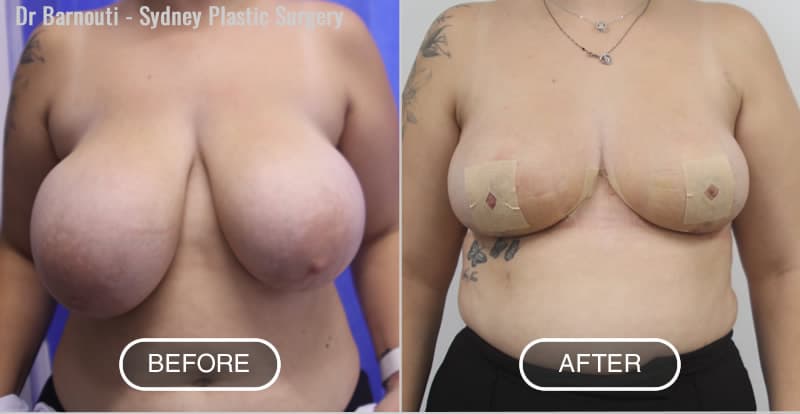 Breast Reduction - Before After