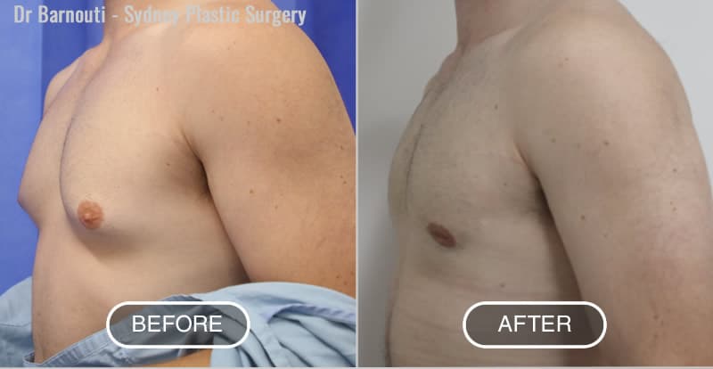 Gynaecomastia Before After