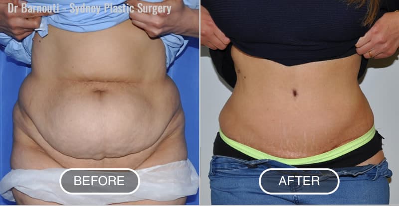 Mummy Makeover - Abdominoplasty