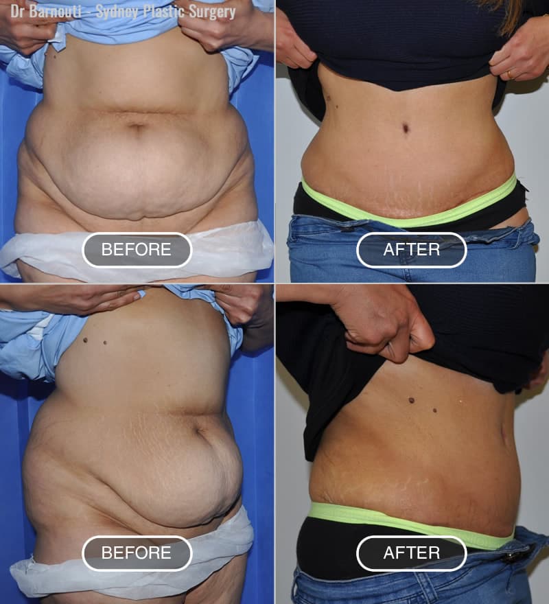 Tummy Tuck Before and After Photo Gallery