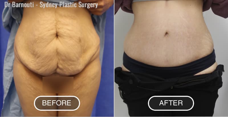 Before After Abdominoplasty - Dr Barnouti