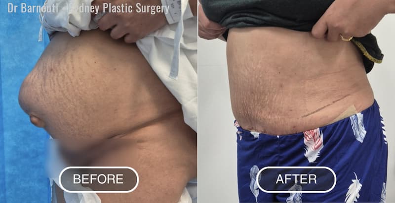 Abdominoplasty Before After