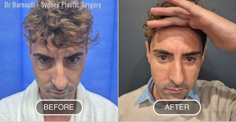 Lower blephroplasty - Lower puffy eyes surgery