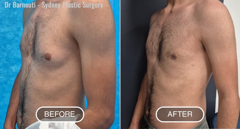 Gynecomastia Before After Photo