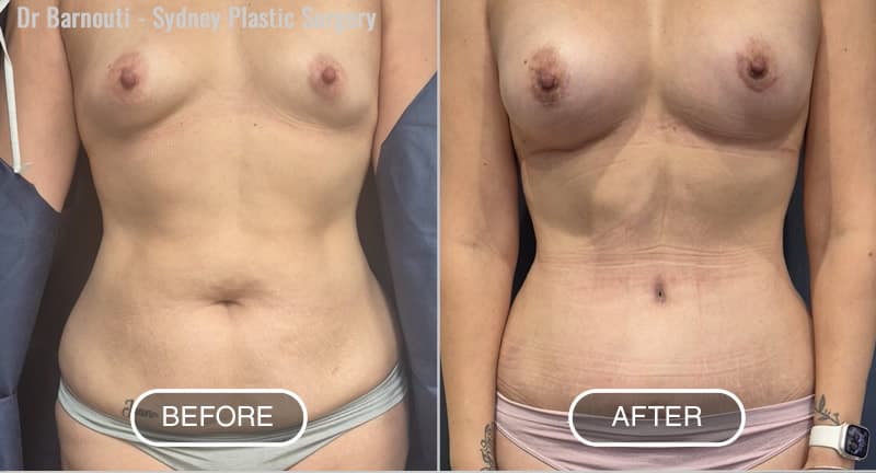 Post Pregnancy Surgery with Abdominoplasty and Breast Augmentation