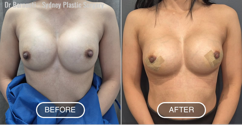Removal and replacement of breast implants and treatment of Synmastia ( Mono breasts). Notice the patient has a better cleavage after surgery. Round Microtextured 330cc implants.