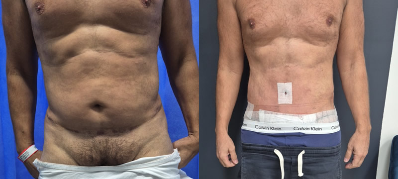 Abdominoplasty and Liposuction