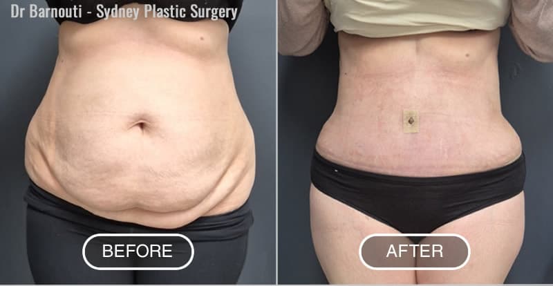 Tummy Tuck Before After