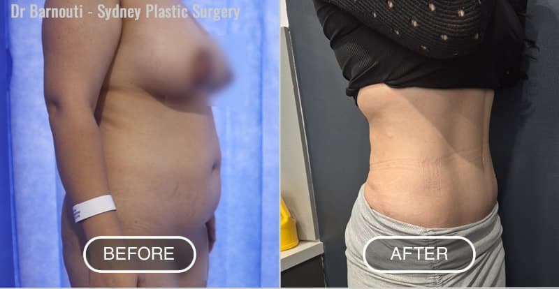 Abdominoplasty Before After Photo