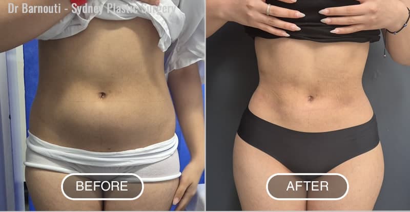 Liposuction Before After Photo