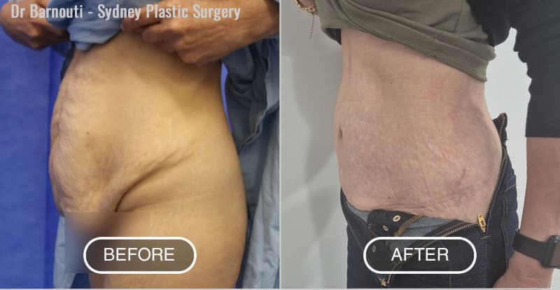 Abdominoplasty Before After Photo