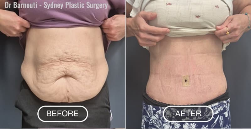 Abdominoplasty Before After