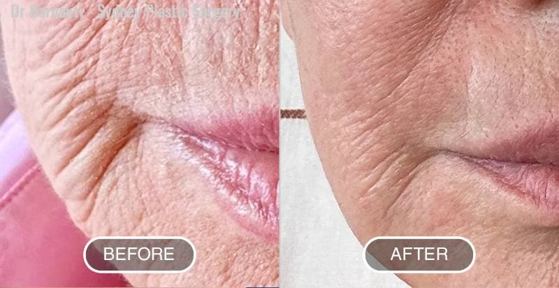 80 year old female, 28 days after one treatment of Laser resurfacing